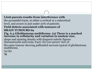 Limb paresis results from interference with
the pyramidal tracts, at either a cortical or a subcortical
level, and occurs in just under 50% of patients.
Field defects associated with tumours of
BRAIN TUMOURS 69
Fig. 6.3 Glioblastoma multiforme. (a) There is a marked
increase in cellularity and variation in nuclear size,
shape and staining density with frequent mitotic figures
(haematoxylin and eosin, ¥40). (b) Low-power view of
the same tumour showing pallisaded necrosis typical of glioblastoma
multiforme.
(a) (b)
70
 