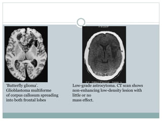 ‘Butterfly glioma’.
Glioblastoma multiforme
of corpus callosum spreading
into both frontal lobes
Low-grade astrocytoma. CT scan shows
non-enhancing low-density lesion with
little or no
mass effect.
 