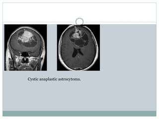 Cystic anaplastic astrocytoma.
 