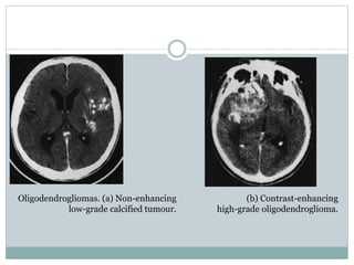 Oligodendrogliomas. (a) Non-enhancing
low-grade calcified tumour.
(b) Contrast-enhancing
high-grade oligodendroglioma.
 