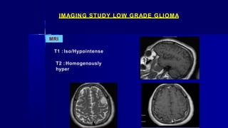 IMAGING STUDY LOW GRADE GLIOMA
MRI
T1 : Iso/Hypointense
T2 : Homogenously
hyper
 
