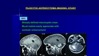 MRI
Sharply defined macrocystic mass
Mural nodule easily appreciate with
contrast enhancement
PILOCYTIC ASTROCYTOMA IMAGING STUDY
 