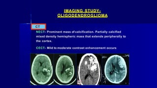 IMAGING STUDY-
OLIGODENDROGLIOMA
CT
NECT- Prominent mass of calcification. Partially calcified
mixed density hemispheric mass that extends peripherally to
the cortex.
CECT- Mild to moderate contrast enhancement occurs
 