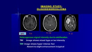 MRI
Heterogenous signal intensity due to calcifiacation
T1W iimage shows mixed hypo or iso intensity
T2W image shows hyper intense foci
Absent to slight enhancement is typical
T-1 T- 1 C T- 2
IMAGING STUDY-
OLIGODENDROGLIOMA
 