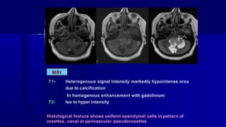 MRI
T1- Heterogenous signal intensity markedly hypointense area
due to calcification
In homogenous enhancement with gadolinium
T2- Iso to hyper intensity
Histological feature shows uniform ependymal cells in pattern of
rosettes, canal or perivascular pseudorosettes
 
