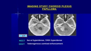 IMAGING STUDY CHOROID PLEXUS
PAPILLOMA
CT
NECT
CECT
Iso or hyperdense, 3/4th hyperdense
heterogenous contrast enhancement
 