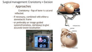 Surgicalmanagement:Craniotomy+ Excision
Approaches
Craniotomy:- flap of bone is cutand
reflected.
- If necessary, combined with either a
stereotactic frame
- or preferably an image guided
system(frameless, steriotaxy) to give
accurate lesion localisation
 