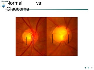 CNS TumorsCNS Tumors
Normal vs
Glaucoma
 