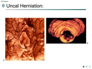 CNS TumorsCNS Tumors
Uncal Herniation:
Inferior view, The
herniated uncus is
bulging over the position
of the tentorium (black
arrows) and
compressing the
midbrain. The two
mammillary bodies (blue
arrows) have been
shifted to the patients
right due to the
pressure.
 
