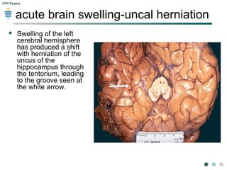 CNS TumorsCNS Tumors
Uncal Herniation:
 