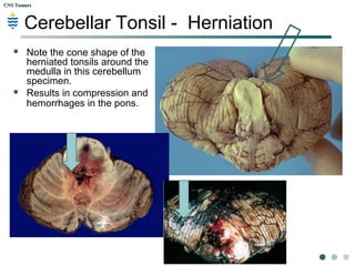 CNS TumorsCNS Tumors
acute brain swelling-uncal herniation
 Swelling of the left
cerebral hemisphere
has produced a shift
with herniation of the
uncus of the
hippocampus through
the tentorium, leading
to the groove seen at
the white arrow.
 