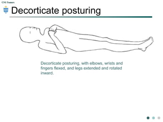 CNS TumorsCNS Tumors
Cerebral Herniation: Pathogenesis
Site ofSite of
herniationherniation EffectEffect Clinical consequenceClinical consequence
Transtentorial Ipsilateral 3rd cranial nerve
compression
Ipsilateral fixed dilated pupil
Ipsilateral 6th cranial nerve
compression
Horizontal diplopia, convergent
squint
Posterior cerebral artery
compression
Occipital infarction Cortical blindness
Cerebral peduncle
compression
Upper motor neurone signs
Brainstem compression and
haemorrhage
Decerebrate posture
Cardiorespiratory failure
Death
Foramen
magnum
Brainstem compression and
haemorrhage
Decerebrate posture
Cardiorespiratory failure Death
Acute obstruction of CSF
pathway
Decerebrate posture
Cardiorespiratory failure
Death
 