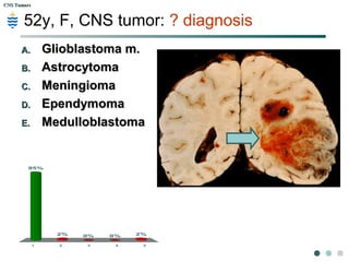 CNS TumorsCNS Tumors
52y, F, CNS tumor: ? diagnosis
1 2 3 4 5
4%
90%
6%
0%0%
A.A. Glioblastoma m.Glioblastoma m.
B.B. AstrocytomaAstrocytoma
C.C. MeningiomaMeningioma
D.D. EpendymomaEpendymoma
E.E. MedulloblastomaMedulloblastoma
 