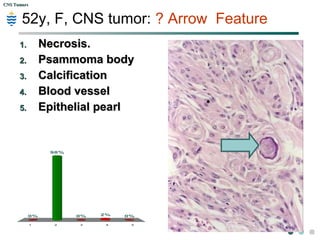 CNS TumorsCNS Tumors
Q:Commonest primary CNS tumor in Adults ?
1 2 3 4 5
15%
73%
0%0%
12%
A.A. Glioblastoma m.Glioblastoma m.
B.B. AstrocytomaAstrocytoma
C.C. MeningiomaMeningioma
D.D. EpendymomaEpendymoma
E.E. MedulloblastomaMedulloblastoma
 