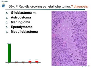 CNS TumorsCNS Tumors
astrocytoma
 