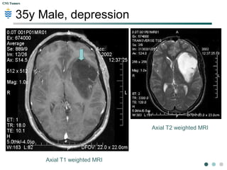 CNS TumorsCNS Tumors
35y Male, depression
2-year history of loss of initiative, depression. He had
slowly lost his drive to win all the big deals he always
done so well at work. 3 months ago he began to
experience headache, which did not respond to
acetaminophen or aspirin. His wife noticed that his
lethargic state had increased in the past few months. 3
days ago his right arm began to convulse uncontrollably
for 1 minute. 1 day ago the patient began again violently
shaking his right arm, and the right side of face began to
twitch at the dinner table. No fever.
Physical exam: Bilateral papilledema, increased deep
tendon reflexes of the right bicep, tricep, +ve babinski
sign on the right foot, reduced leg strength on the right.
 