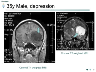 CNS TumorsCNS Tumors
35y Male, depression
Axial T1 weighted MRI
Axial T2 weighted MRI
 