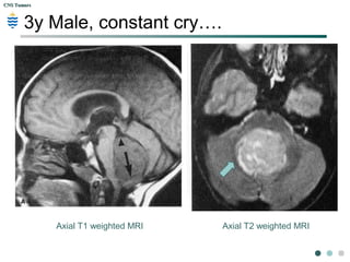 CNS TumorsCNS Tumors
3y Male, constant cry….
Constant crying and not interacting with other
children at daycare since 1m. Mother noticed
that he was pointing to his head often. Family
physician who stated that he was developing
normally, and that the “ terrible two’s” are difficult
period for parents. Recently started vomiting on
a daily basis and started wobbling even though
he learned to walk 6 months ago.
Physical: Bilateral papilledema and gait ataxia
was noted on the physical exam.
 