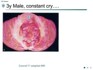 CNS TumorsCNS Tumors
Axial T1 weighted MRI Axial T2 weighted MRI
3y Male, constant cry….
 
