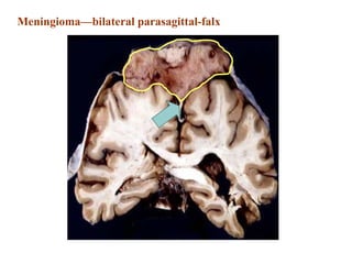 Meningioma—bilateral parasagittal-falx
 