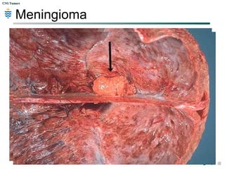 CNS TumorsCNS Tumors
Meningioma
 