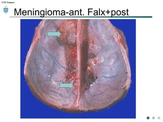 CNS TumorsCNS Tumors
Meningioma-ant. Falx+post
 