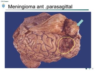 CNS TumorsCNS Tumors
Meningioma ant .parasagittal
 