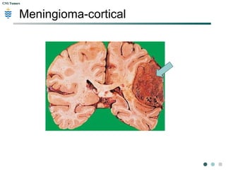 CNS TumorsCNS Tumors
Meningioma-cortical
 