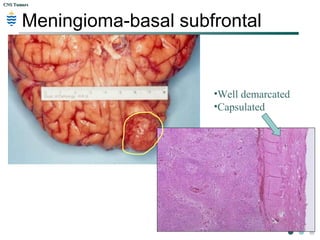 CNS TumorsCNS Tumors
Meningioma-basal subfrontal
•Well demarcated
•Capsulated
 