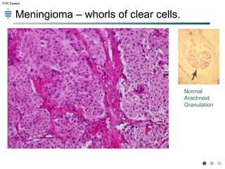 CNS TumorsCNS Tumors
Meningioma – whorls of clear cells.
Normal
Arachnoid
Granulation
 