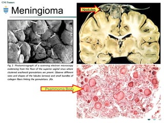 CNS TumorsCNS Tumors
Meningioma NodulesNodules
Psammoma Body
 