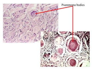 Psammoma bodies
 