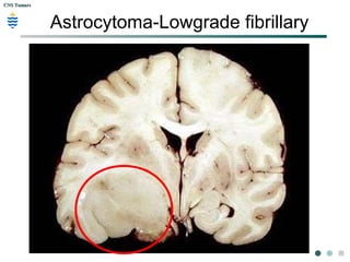 CNS TumorsCNS Tumors
Astrocytoma-Lowgrade fibrillary
 