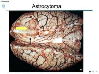 CNS TumorsCNS Tumors
Astrocytoma
 