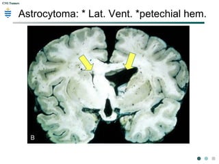 CNS TumorsCNS Tumors
Astrocytoma: * Lat. Vent. *petechial hem.
 
