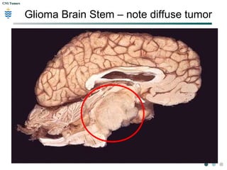 CNS TumorsCNS Tumors
Glioma Brain Stem – note diffuse tumor
 