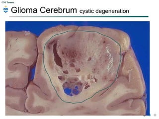 CNS TumorsCNS Tumors
Glioma Cerebrum cystic degeneration
 