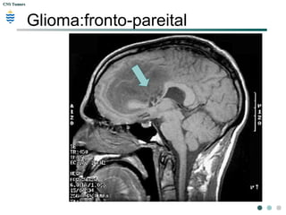 CNS TumorsCNS Tumors
Glioma:fronto-pareital
 