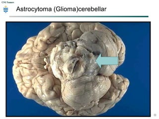 CNS TumorsCNS Tumors
Astrocytoma (Glioma)cerebellar
 