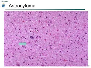 CNS TumorsCNS Tumors
Astrocytoma
 