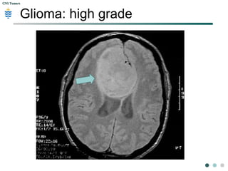 CNS TumorsCNS Tumors
Glioma: high grade
 