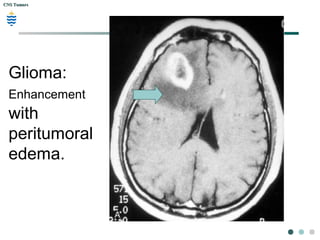 CNS TumorsCNS Tumors
Glioma:
Enhancement
with
peritumoral
edema.
 
