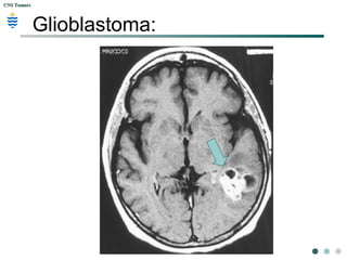 CNS TumorsCNS Tumors
Glioblastoma:
 
