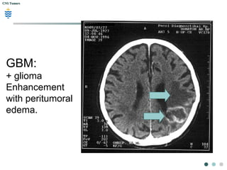 CNS TumorsCNS Tumors
GBM:
+ glioma
Enhancement
with peritumoral
edema.
 
