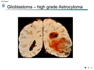 CNS TumorsCNS Tumors
Glioblastoma – high grade Astrocytoma
 