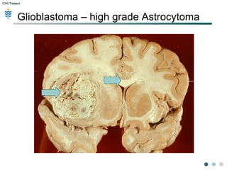 CNS TumorsCNS Tumors
Glioblastoma – high grade Astrocytoma
 