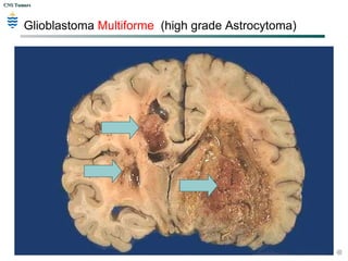 CNS TumorsCNS Tumors
Glioblastoma Multiforme (high grade Astrocytoma)
 