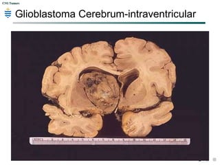 CNS TumorsCNS Tumors
Glioblastoma Cerebrum-intraventricular
 