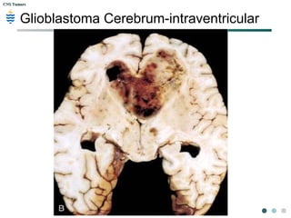 CNS TumorsCNS Tumors
Glioblastoma Cerebrum-intraventricular
 