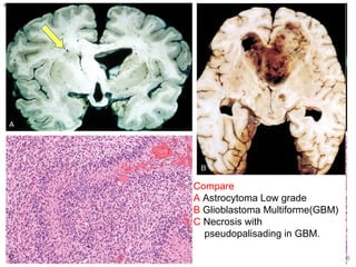 CNS TumorsCNS Tumors
Compare
A Astrocytoma Low grade
B Glioblastoma Multiforme(GBM)
C Necrosis with
pseudopalisading in GBM.
 